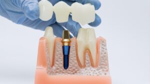 dental implants bone loss, implant options bone loss, dental implant procedures, implant solutions for bone loss, affordable dental implants, bone graft dental implants, implant dentist near me, missing teeth replacement, permanent tooth restoration, dental implant specialists